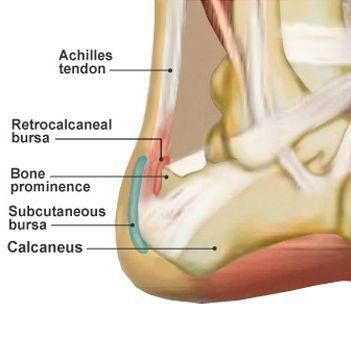 Achilles Tendon and/or Heel Pain 